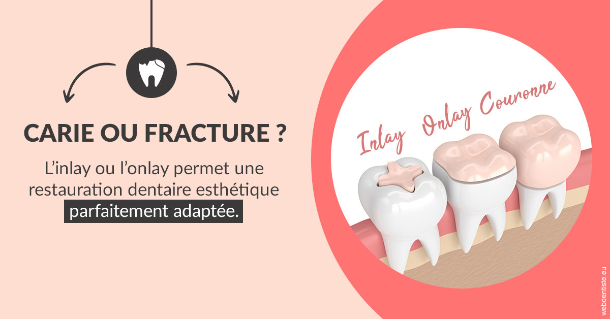 https://dr-rohr-marc.chirurgiens-dentistes.fr/T2 2023 - Carie ou fracture 2
