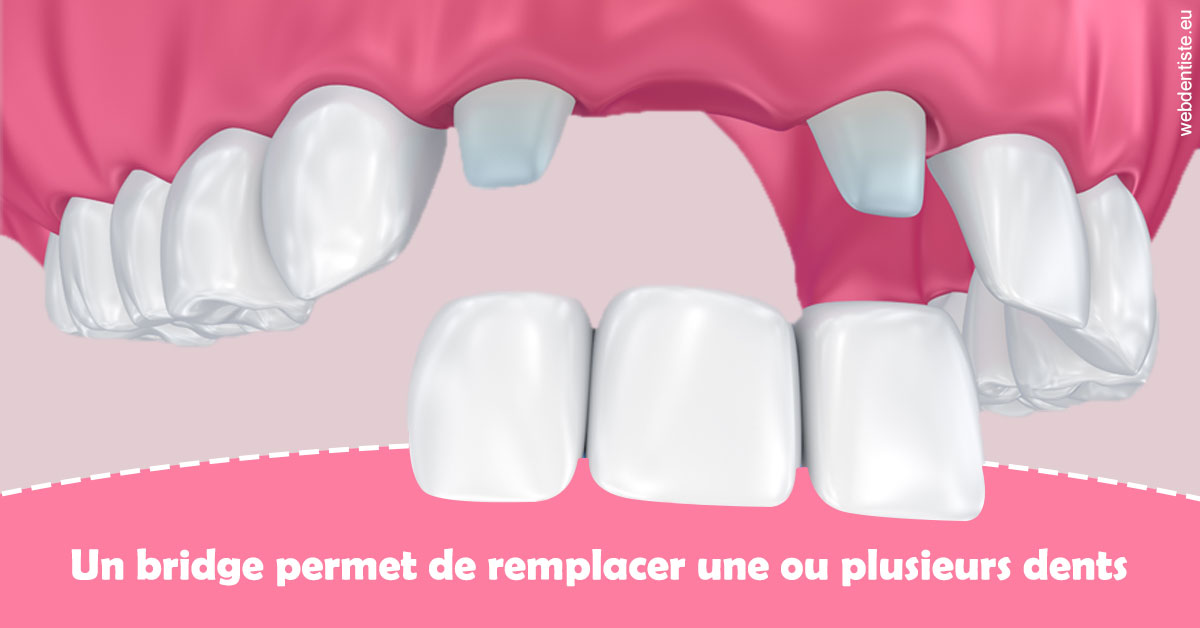 https://dr-rohr-marc.chirurgiens-dentistes.fr/Bridge remplacer dents 2