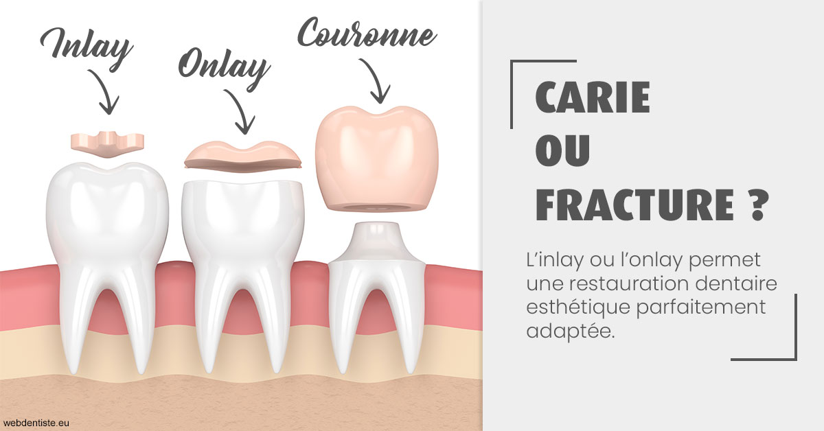 https://dr-rohr-marc.chirurgiens-dentistes.fr/T2 2023 - Carie ou fracture 1