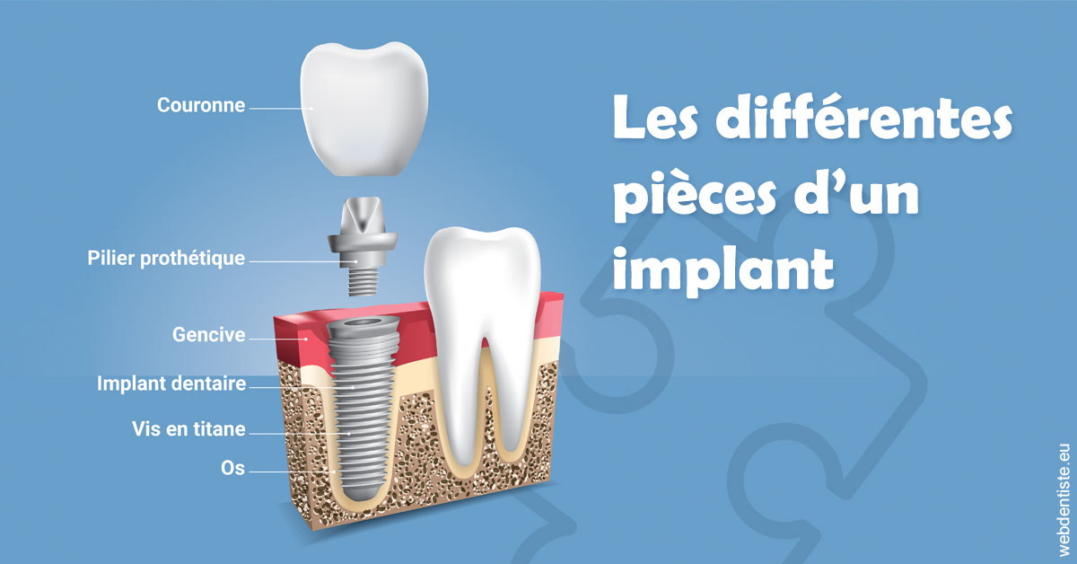 https://dr-rohr-marc.chirurgiens-dentistes.fr/Les différentes pièces d’un implant 1